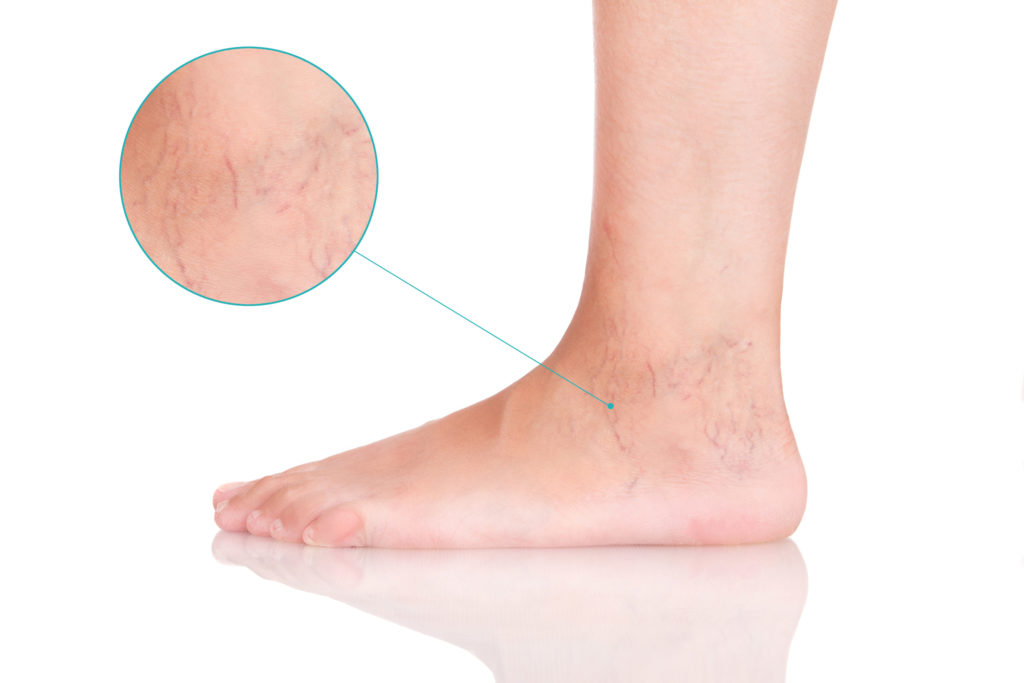 No Surgery; No Downtime: Sclerotherapy for Treating Varicose and Spider  Veins 