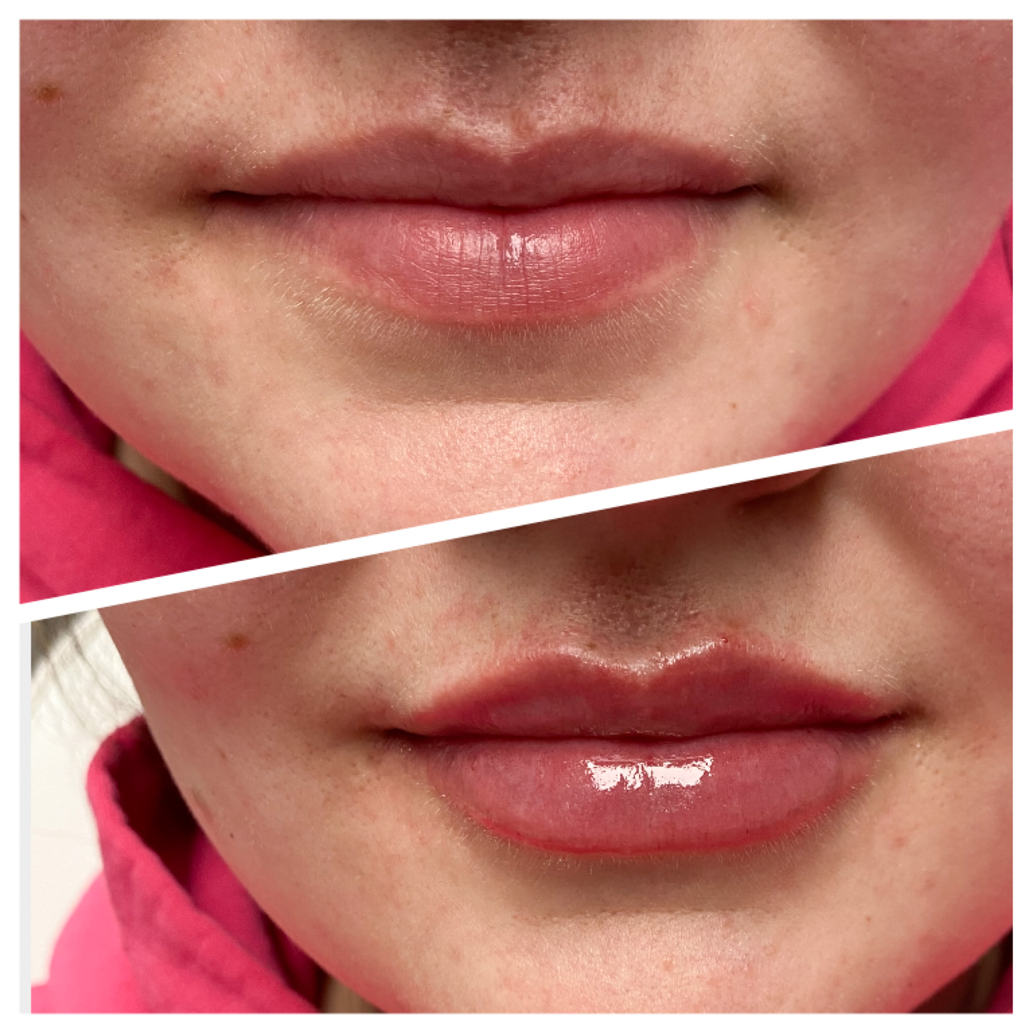 Lipfiller | Girl | Before and After | Skintuition Medical Aesthetics