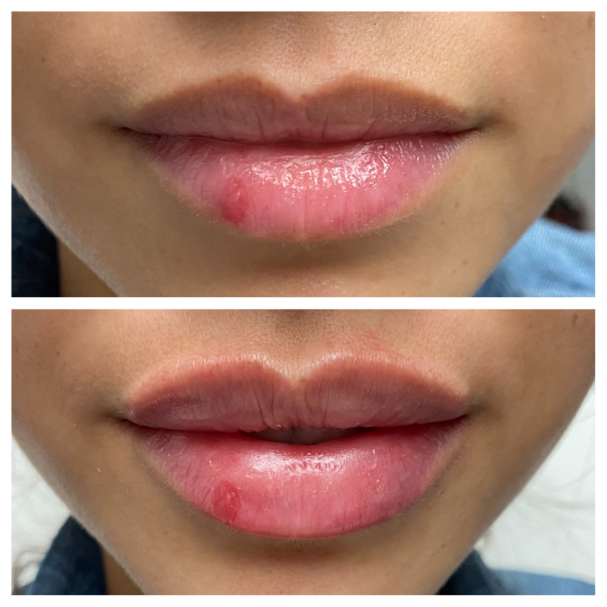 Derma Fillers | Girl | Before and after | Skintuition Medical Aesthetics