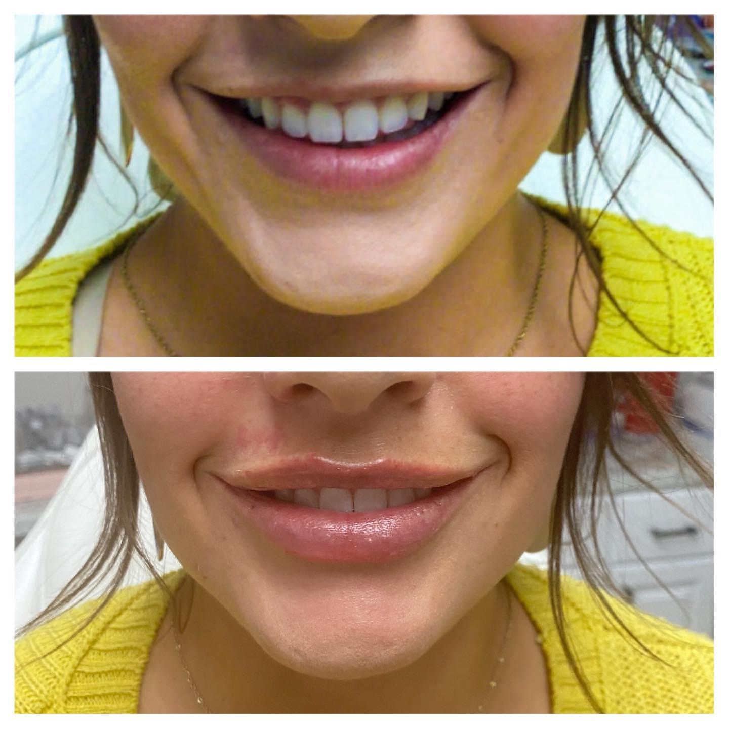 Dermal fillers | Lady | Smile | Before and after | Skintuition Medical Aesthetics