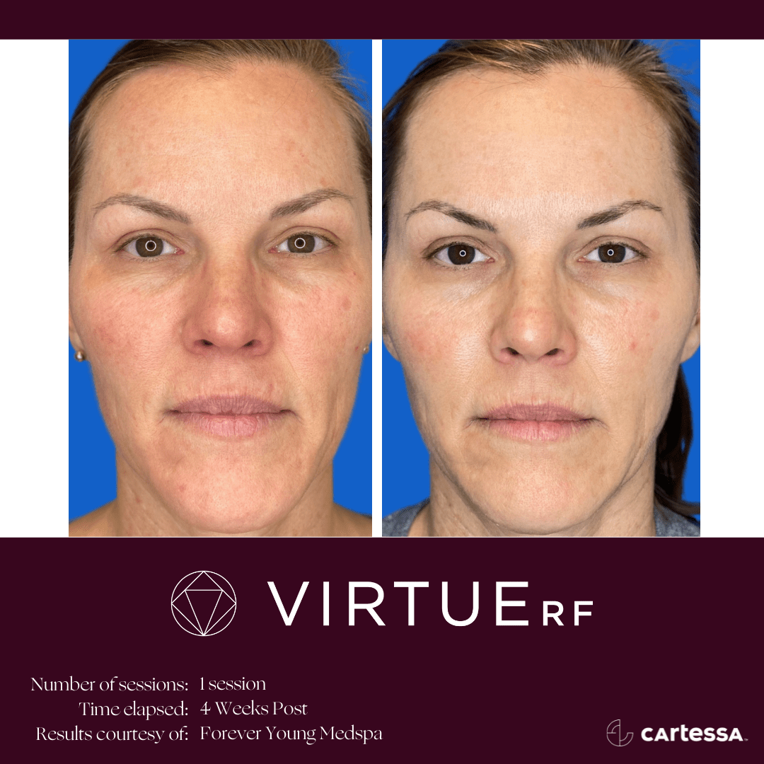 Virtue RFBA Face Texture 4 min