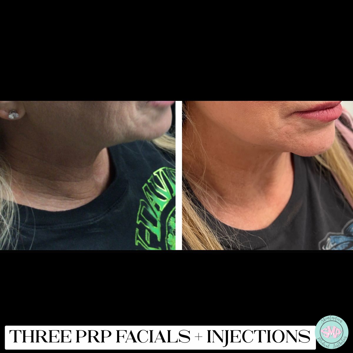 Three Natural Growth Factor Injections facials + Injections