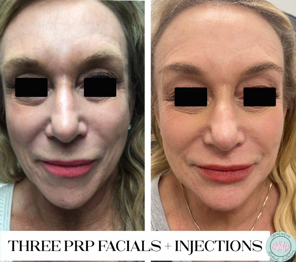 Skintuition Medical Aesthetics | Three Natural Growth Factor Injections facials Injections