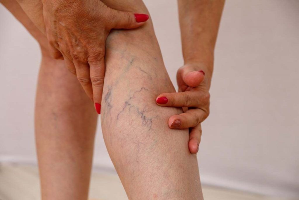 Spider Veins by Skintuition Medical Aesthetics in Pocatello ID