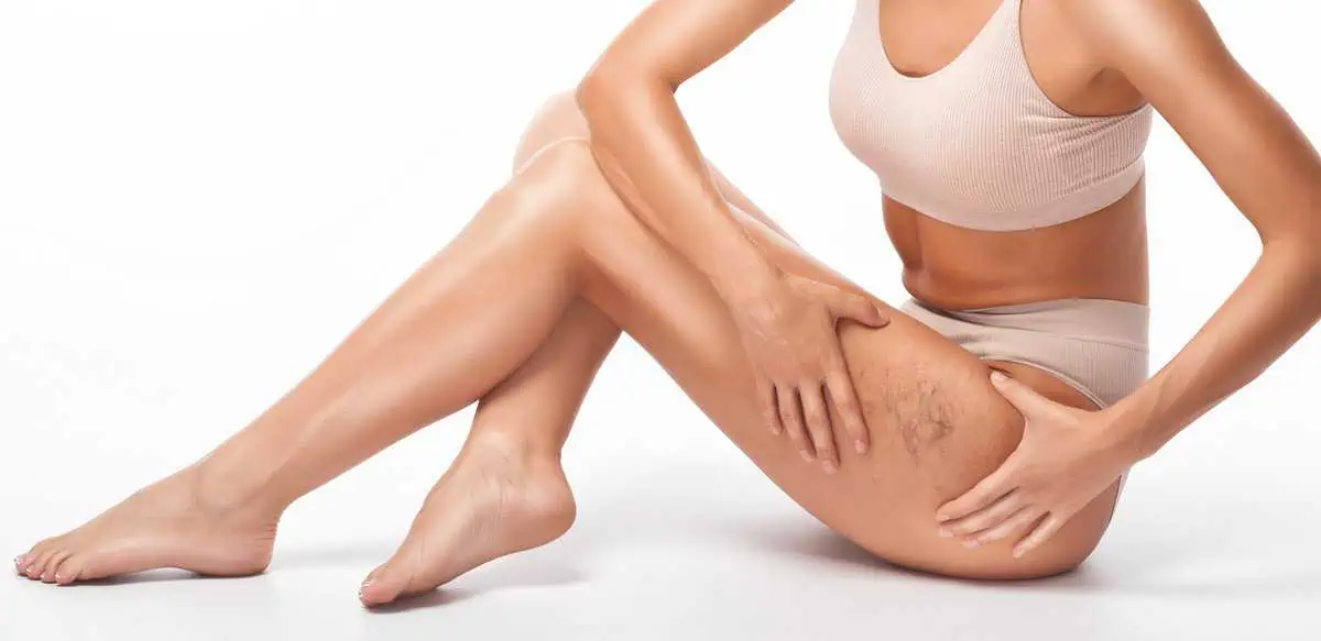 Spider Veins Treatment by Skintuition Medical Aesthetics In Pocatello ID