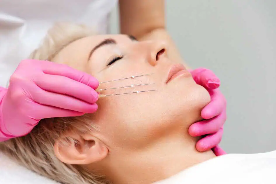 PDO Thread Lift In Pocatello, ID by Skintuition Medical Aesthetics