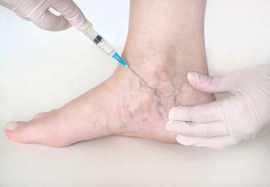 Spider Vein Treatment In Pocatello, ID by Skintuition Medical Aesthetics