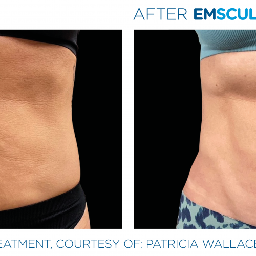Emsculpt Neo Before and After