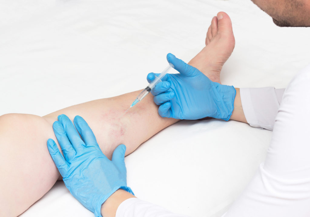 Sclerotherapy: The Most Frequently Asked Questions and Answer | Pocatello, ID USA | Skintuition Medical Aesthetics