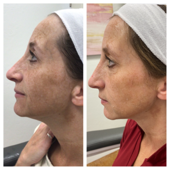 Before and After | Skin care | Women | Skintuition Medical Aesthetics