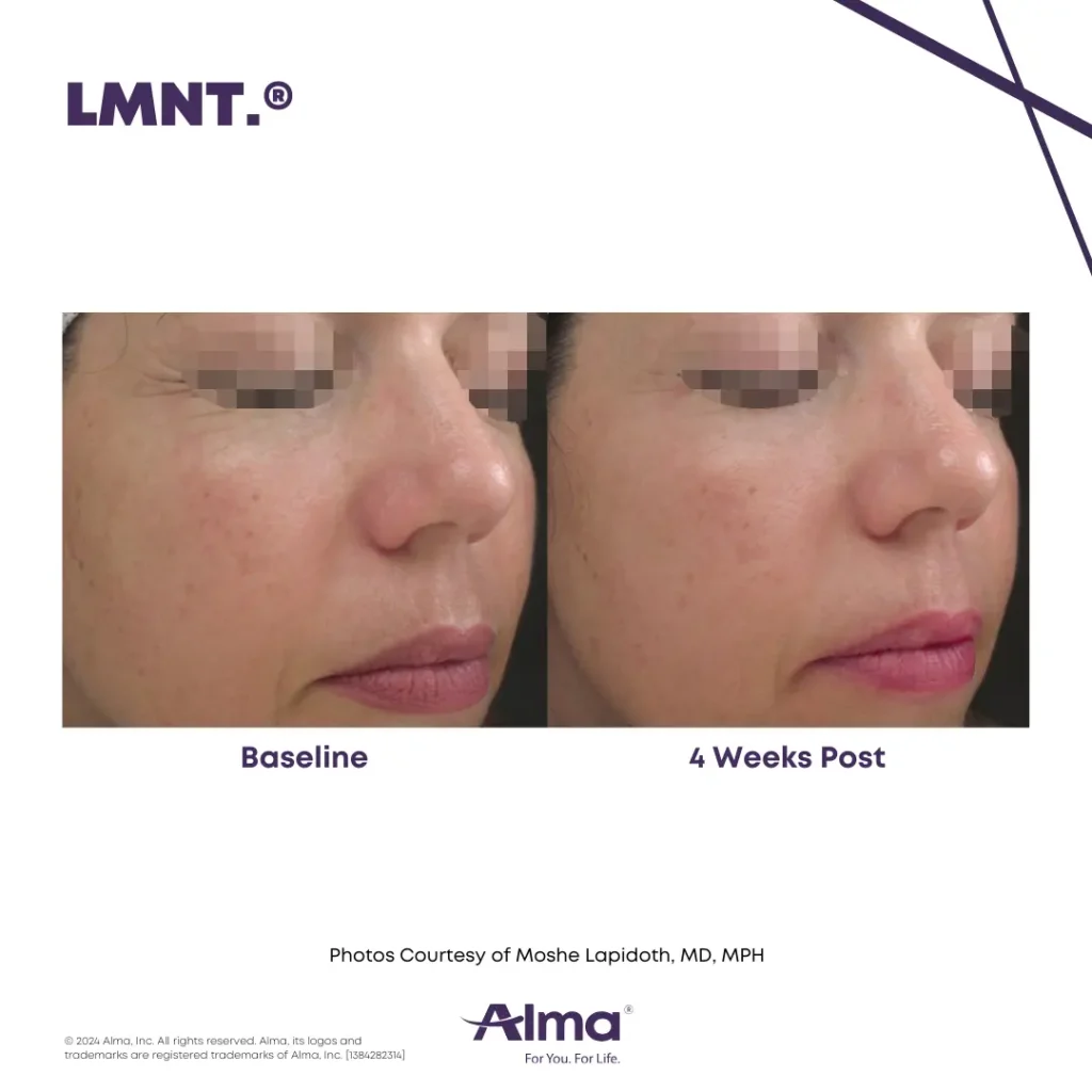 Product-Render-Hand-Piece-On-scaled | Skintuition Medical Aesthetics in Pocatello, ID, USA