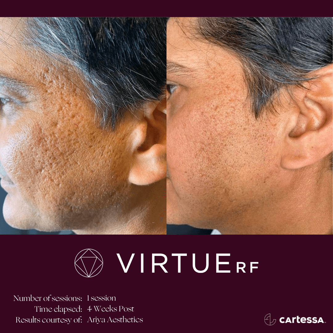 Virtue RFBA Face Acne Scars | Skintuition Medical Aesthetics in Pocatello, ID, USA