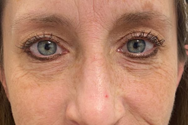 VI Peel Chemical Peels 2 After