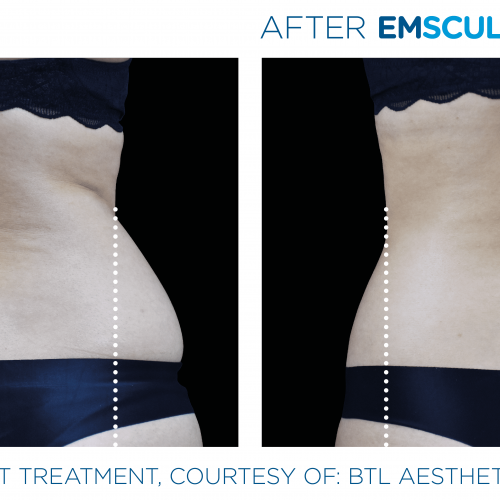 Emsculpt_Neo Before and After (1)