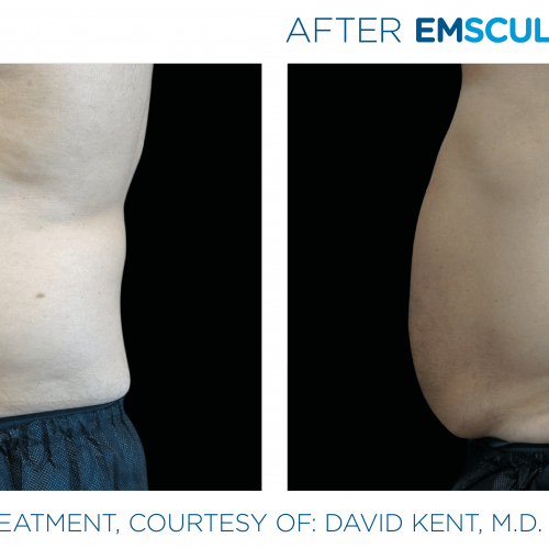Emsculpt_Neo Before and After (2)