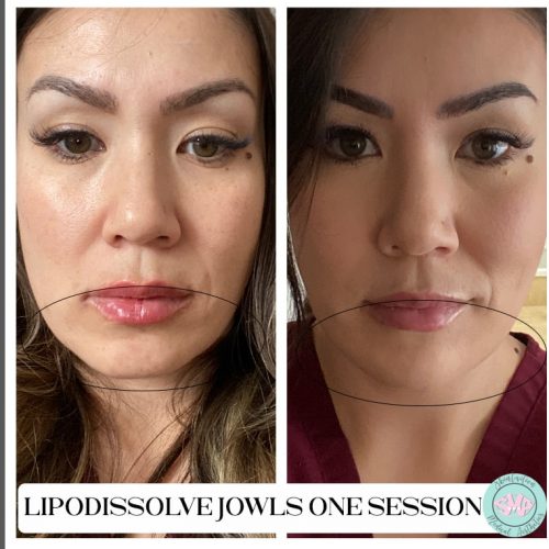Lipodissolvejowls