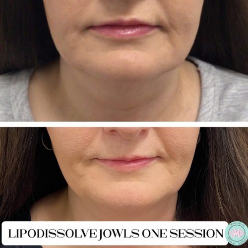 Lipodissolvejowls1sesh