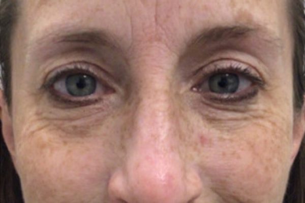 VI Peel Chemical Peels 1 Before